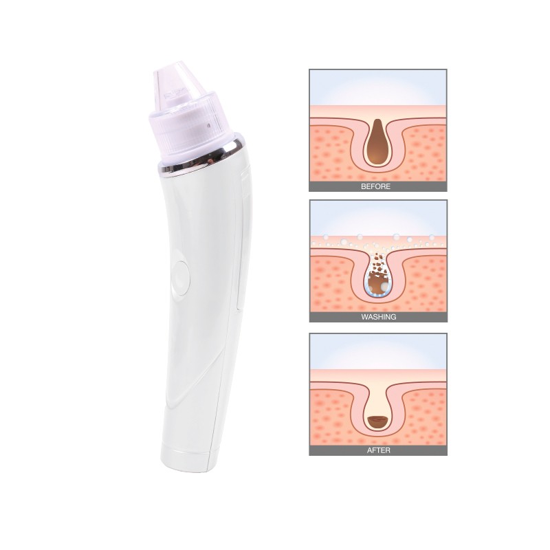 7712422portable Blackhead Vacuum Removal 